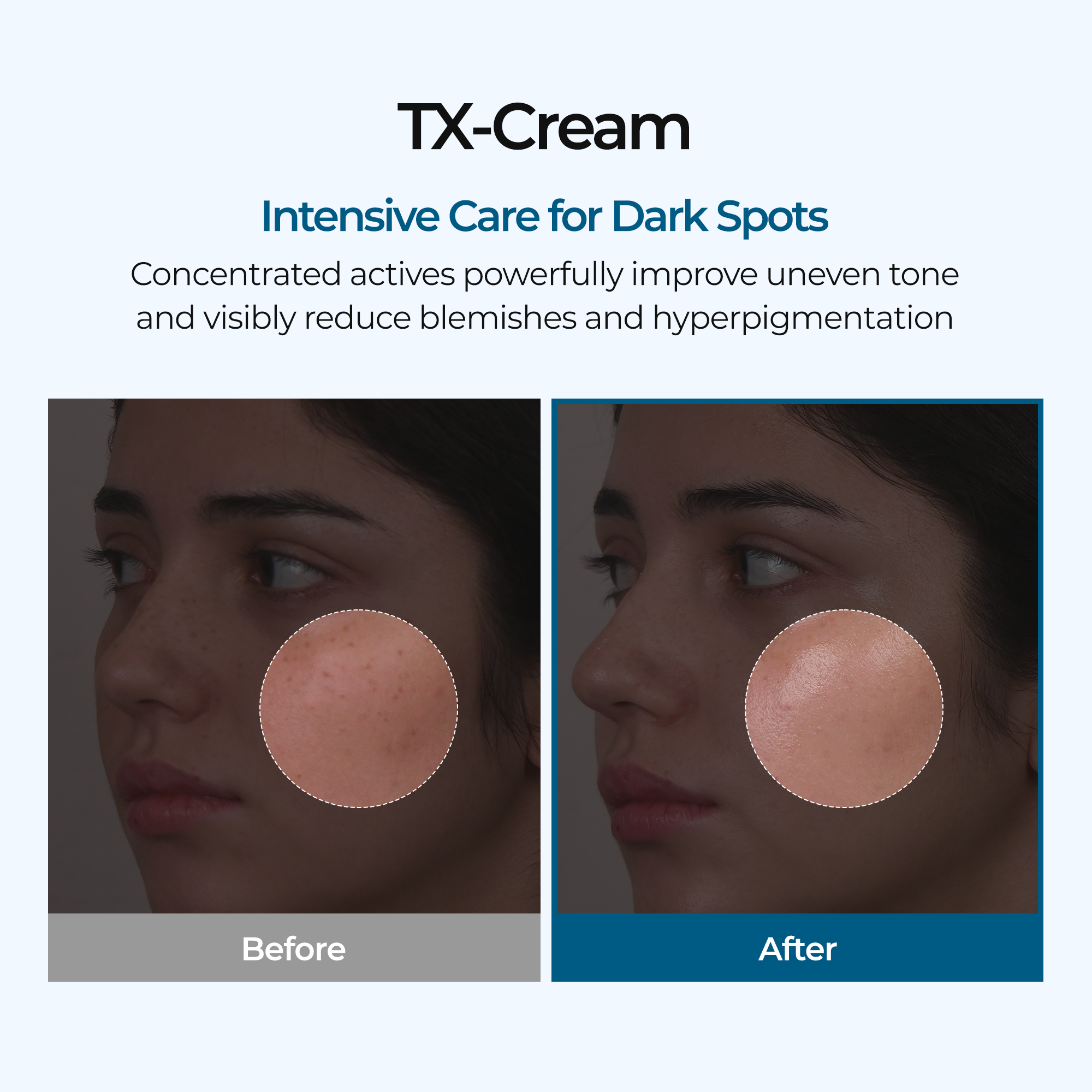 TX Cream Anti-Taches - Acide Tranexamique 35 000ppm